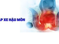 Triệu chứng bệnh apxe hậu môn và cách chữa