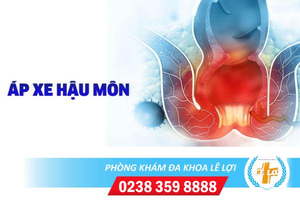 Triệu chứng bệnh apxe hậu môn và cách chữa