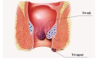 Thuốc chữa bệnh trĩ sử dụng loại nào tốt?