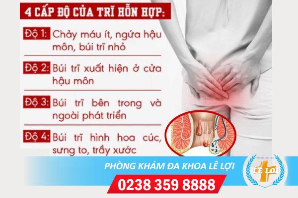 Dấu hiệu và cách điều bệnh trị trĩ hỗn hợp hiệu quả