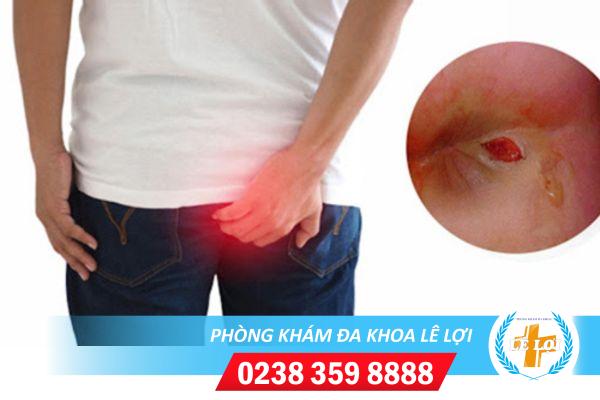 Hậu môn chảy mủ do đâu và cách điều trị hiệu quả