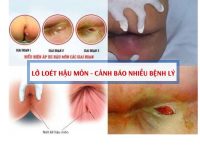 Lở loét hậu môn do đâu và cách điều trị