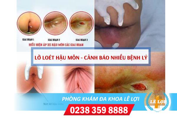 Lở loét hậu môn do đâu và cách điều trị