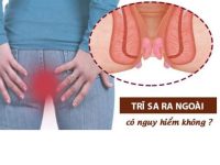 Sa Búi Trĩ, Triệu Chứng Và Phương Pháp Hỗ Trợ Điều Trị Hiệu Quả