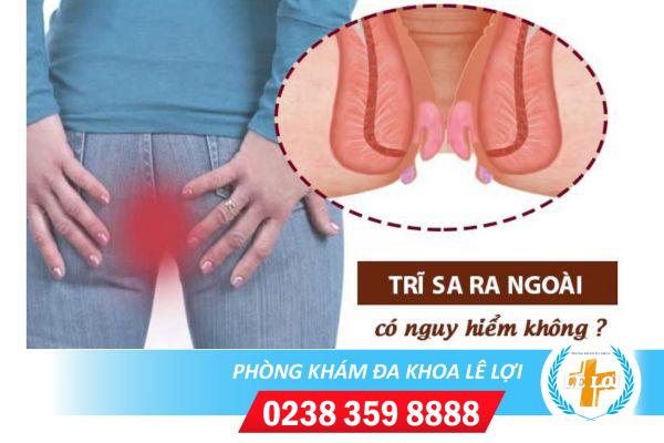 Sa Búi Trĩ, Triệu Chứng Và Phương Pháp Hỗ Trợ Điều Trị Hiệu Quả