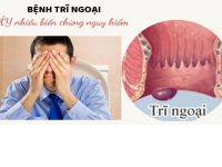 Bệnh trĩ ngoại là gì dấu hiệu nhận biết