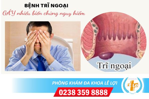 Bệnh trĩ ngoại là gì dấu hiệu nhận biết