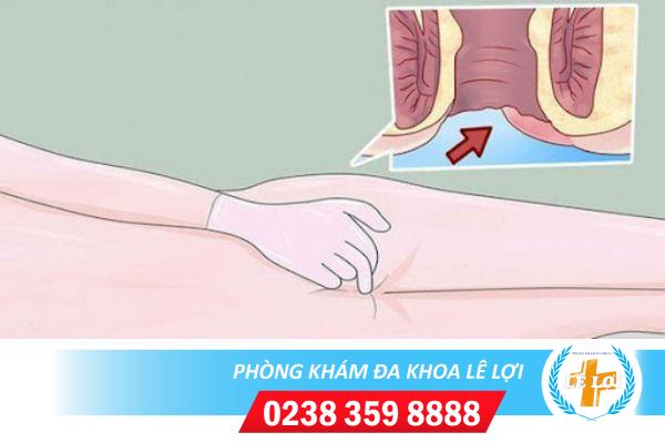 Nổi hạch ở hậu môn có nguy hiểm không?