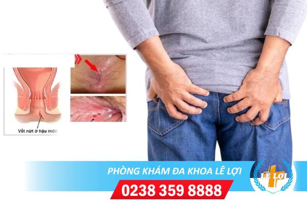 Bị rách hậu môn khi đi cầu là bệnh gì?