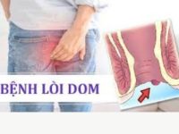 Cách nhận biết bệnh lòi dom