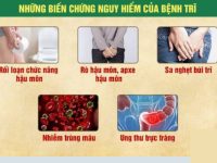 Giải đáp bệnh trĩ có nguy hiểm không từ chuyên gia