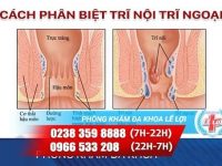 Phân biệt trĩ nội, trĩ ngoại như thế nào?