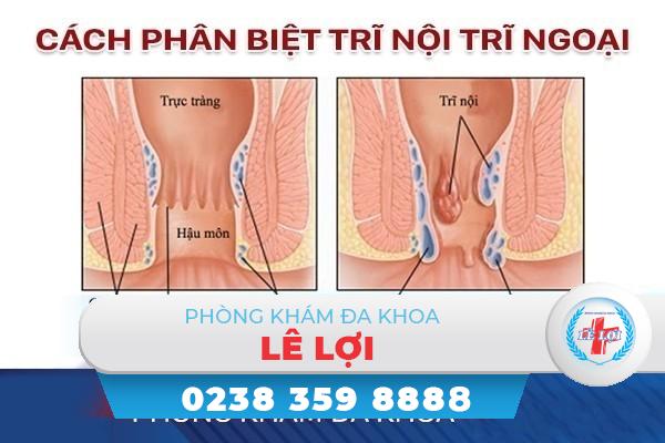 Phân biệt trĩ nội, trĩ ngoại như thế nào?