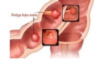 Nguyên nhân gây polyp hậu môn và cách điều trị