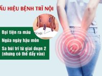 Dấu hiệu bệnh trĩ nội và cách điều trị