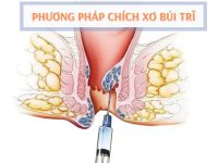 Chích xơ búi trĩ có hiệu quả không?