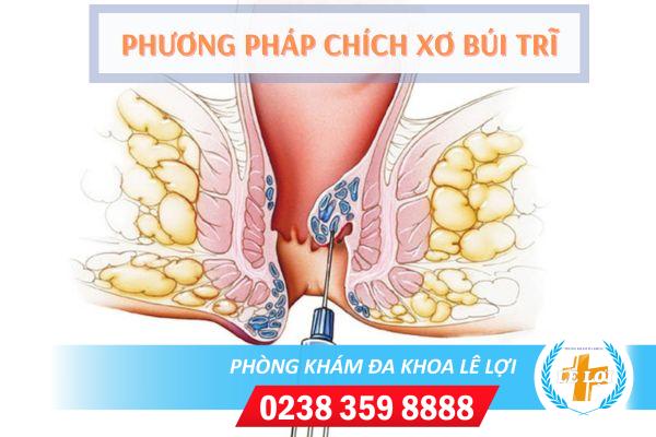 Chích xơ búi trĩ có hiệu quả không?