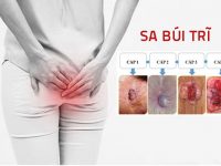 Cẩn thận với biến chứng sa búi trĩ