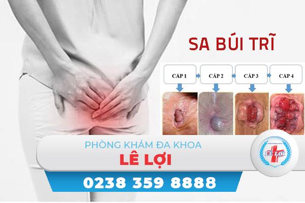 Cẩn thận với biến chứng sa búi trĩ