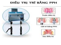 Cắt trĩ bằng phương pháp PPH hiệu quả không?