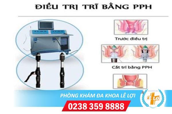 Cắt trĩ bằng phương pháp PPH hiệu quả không?