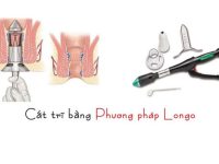 Phương pháp cắt trĩ Longo có tốt không