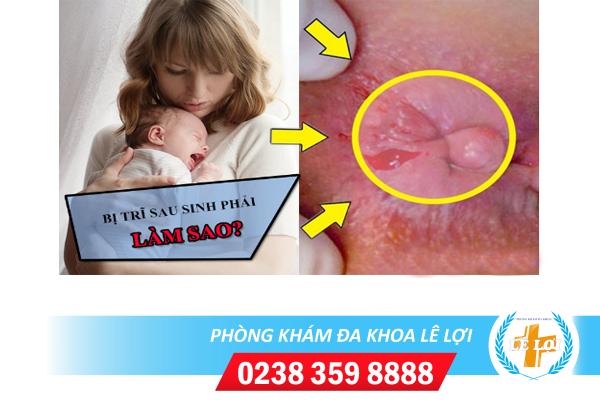 Cách chữa trị bệnh trĩ sau sinh