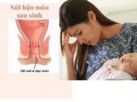 Nứt kẽ hậu môn sau sinh phải làm sao?