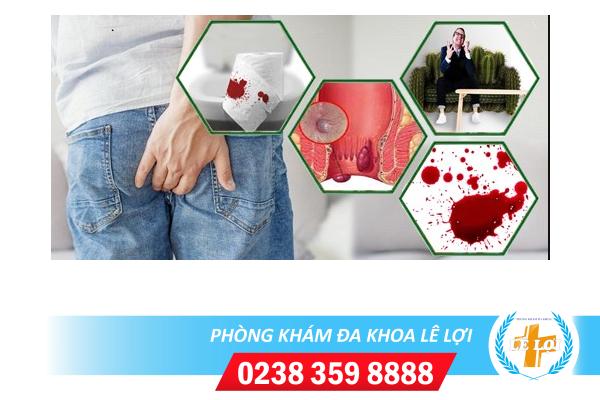 Những dấu hiệu giúp nhận biết bệnh trĩ kịp thời