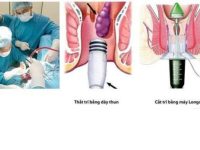 Các phương pháp cắt trĩ hiệu quả