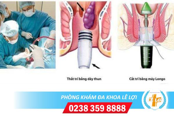 Các phương pháp cắt trĩ hiệu quả