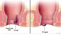 Mẹo chữa bệnh trĩ tại nhà dễ thực hiện