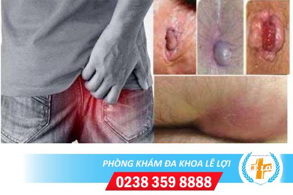 Đau hậu môn là bị bệnh gì?