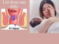 Lòi dom sau sinh dấu hiệu và cách điều trị