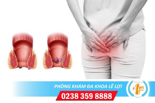 Nhói hậu môn là bị bệnh gì?