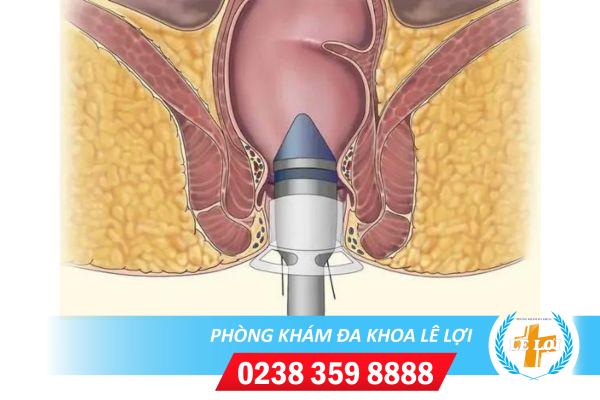 Phương pháp cắt trĩ nội – chi phí cắt trĩ nội bao nhiêu?