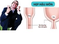 Dấu hiệu hẹp hậu môn và cách điều trị