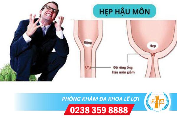 Dấu hiệu hẹp hậu môn và cách điều trị