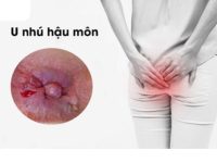 U nhú hậu môn là bệnh gì nguy hiểm không?