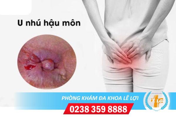 U nhú hậu môn là bệnh gì nguy hiểm không?