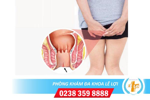 Rách hậu môn sau sinh nguyên nhân và cách điều trị