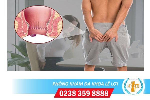 Búi trĩ lồi ra ngoài nguyên nhân và cách điều trị