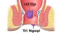 Cách phân biệt trĩ nội trĩ ngoại