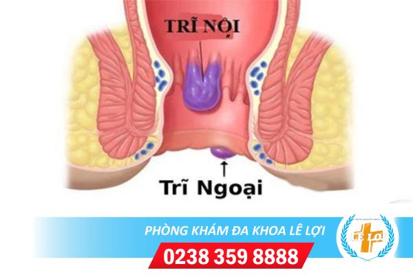 Cách phân biệt trĩ nội trĩ ngoại