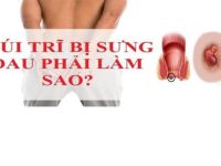 Đau búi trĩ phải làm sao?