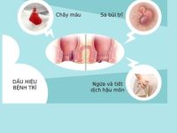 Bị bệnh trĩ nên làm gì – làm gì để hết trĩ?