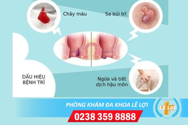 Bị bệnh trĩ nên làm gì – làm gì để hết trĩ?