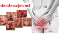 Hình ảnh bệnh trĩ qua từng cấp độ và cách điều trị