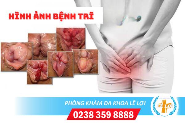 Hình ảnh bệnh trĩ qua từng cấp độ và cách điều trị