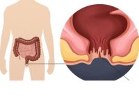 Nguyên nhân viêm hậu môn và cách điều trị nhanh khỏi